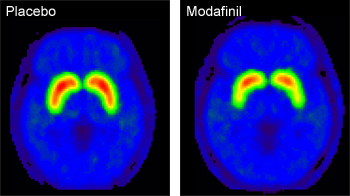 PET images of the brain